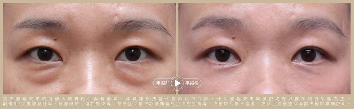眼袋轉移術前後