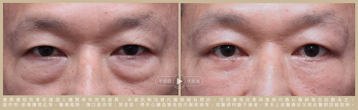 眼袋轉移術前後
