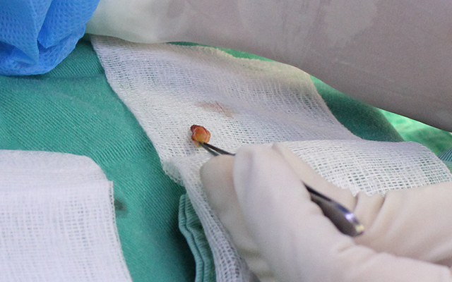 「外開式眼袋手術」過程中幫Lihua的眼袋脂肪取出 照片