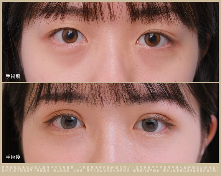 術前術後比一比 照片