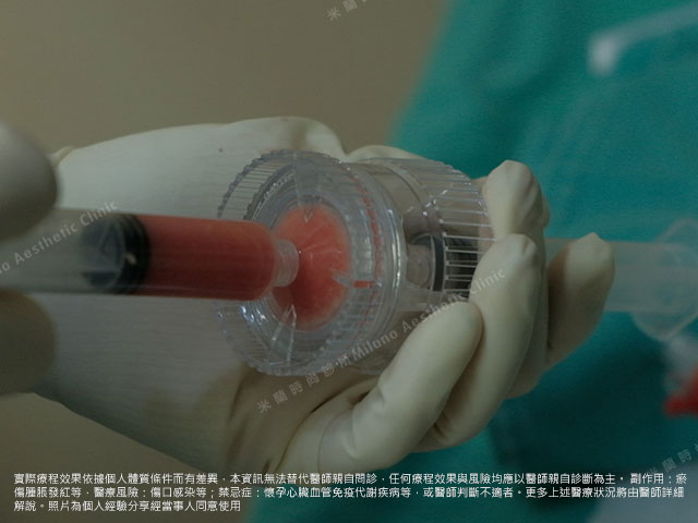 威萃脂肪純化