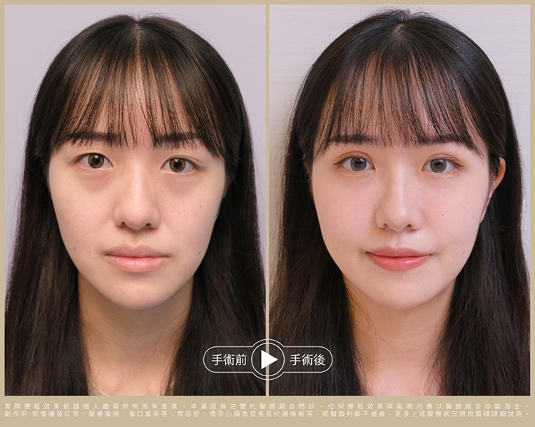 告別疲憊感三件套前術後比一比