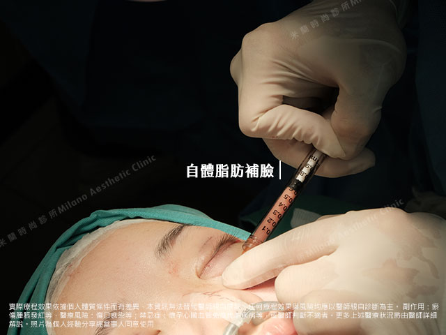 自體脂肪豐臉