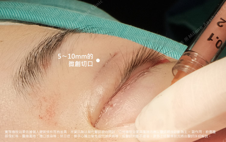 上眼瞼區域為雙眼皮的切口