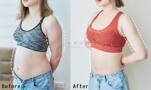 自體脂肪隆乳/豐胸減脂豐胸案例術後追蹤 圖片