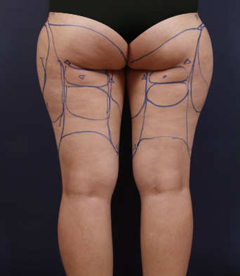 由醫師親自於術前確認臀、腿需要減脂部位，並畫線標記。