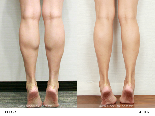 美腿術瘦小腿案例