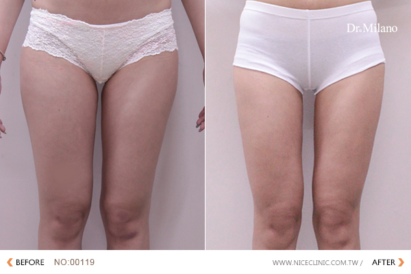 米蘭隱痕飛塑減脂瘦腿(瘦出大腿縫)術後三個月