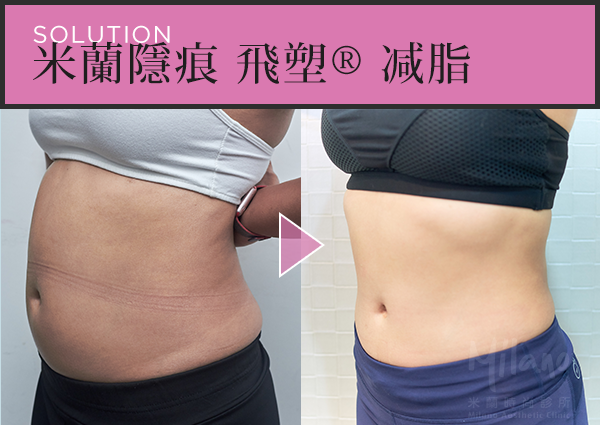 腹部術後