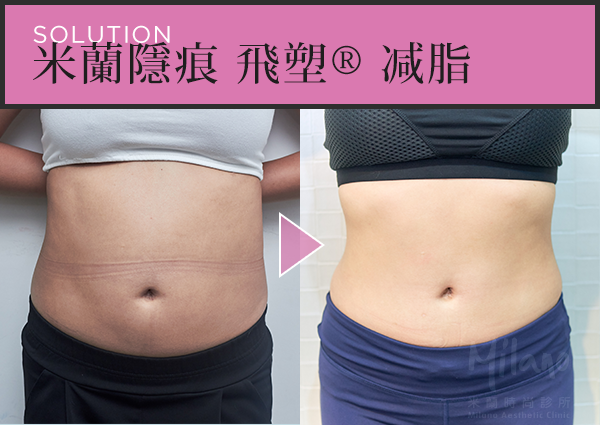 腹部術後
