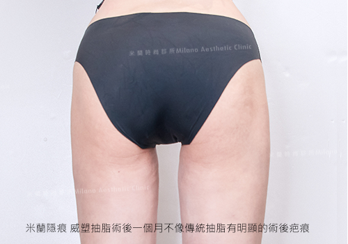 米蘭隱痕威塑抽脂技術傷口隱藏