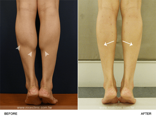 瘦小腿術前術後的比較