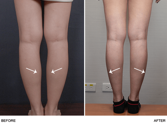 瘦小腿術前術後的比較