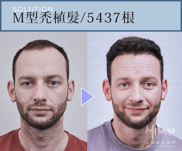 拯救Ｍ型禿 回復年輕感