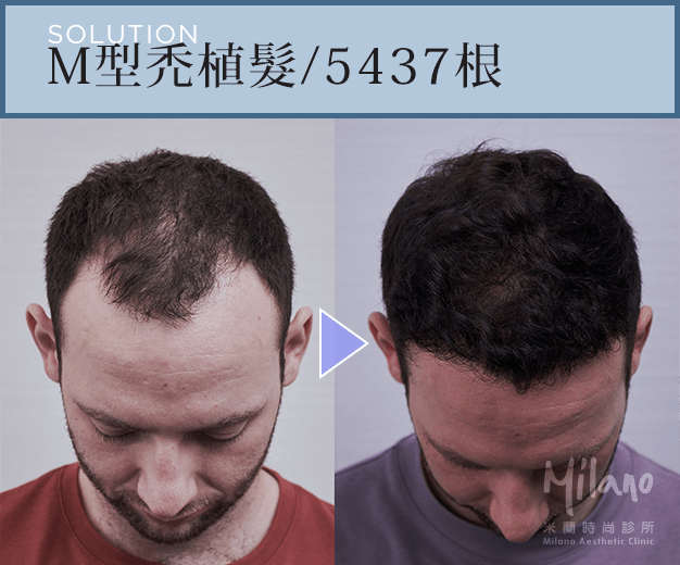 拯救Ｍ型禿 回復年輕感