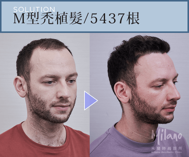 拯救Ｍ型禿 回復年輕感
