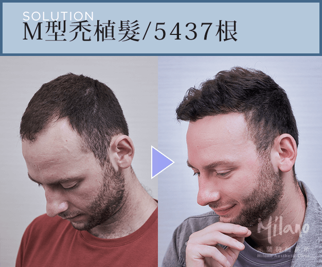 拯救Ｍ型禿 回復年輕感