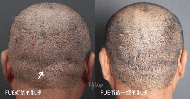 FUE毛囊單位取髮-微創植髮後留下來的疤痕