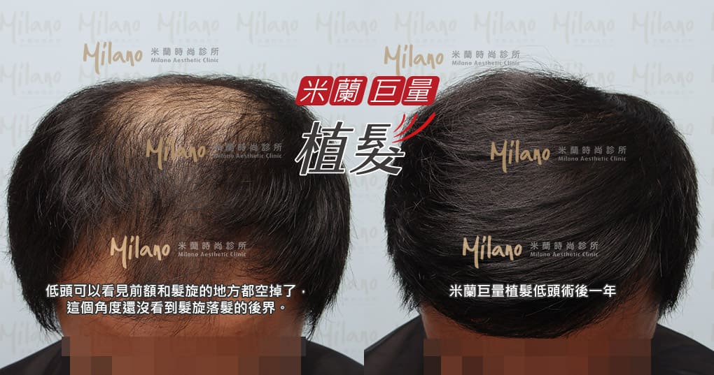 米蘭巨量植髮術後一年比較