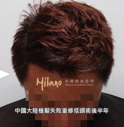 中國大陸植髮失敗重修正面術後半年