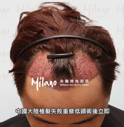中國大陸植髮失敗重修低頭術後立即