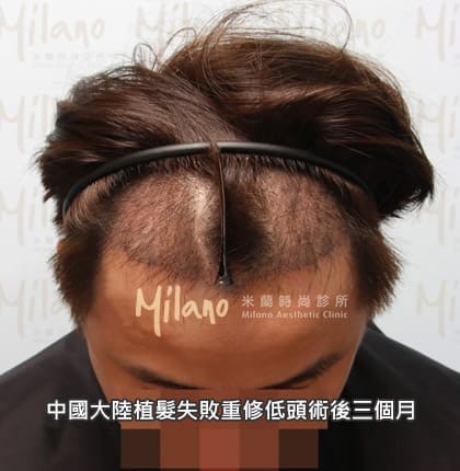 中國大陸植髮失敗重修術後三個月