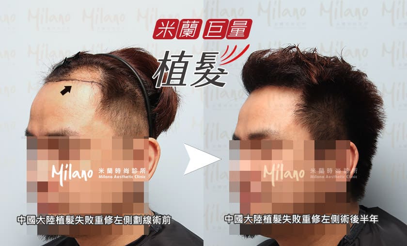 中國大陸植髮失敗重修正面術後半年