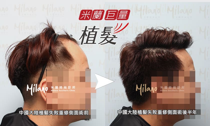 中國大陸植髮失敗重修右側術後半年