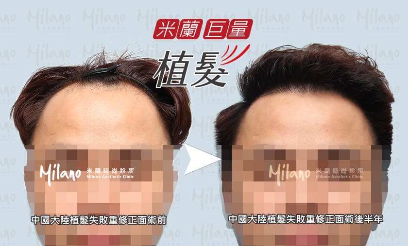 中國大陸植髮失敗重修左側術後半年