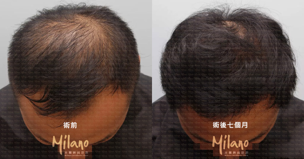 因為有合併生髮水的關係，頭頂的改善十分明顯，注意這是術後七個月的狀態，一般到一年還會改善更多。