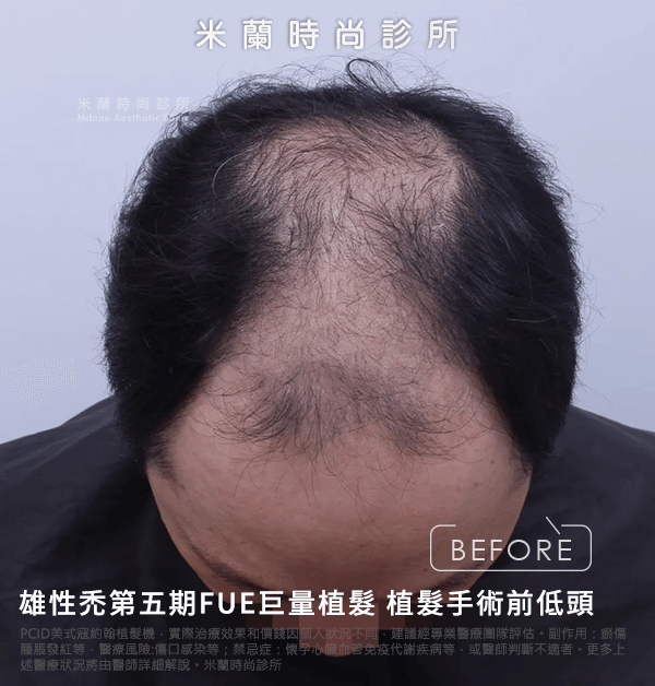 雄性禿第五期FUE巨量植髮
