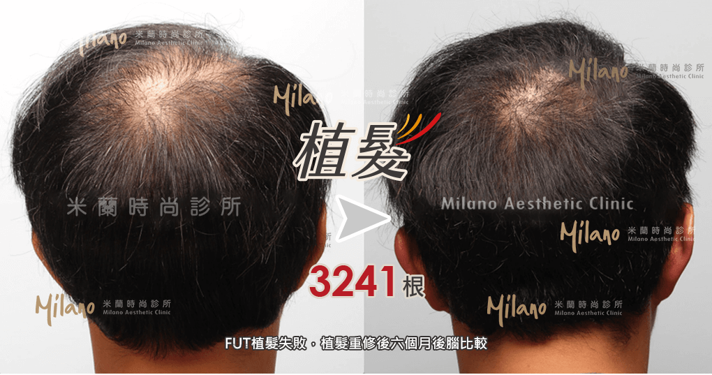 二次植髮重修術後六個月右側比較