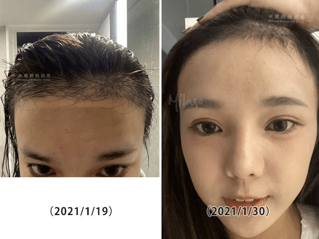 女性植髮改善高髮際線術後滿五個月