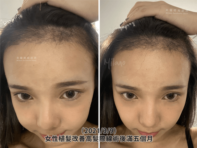 女性植髮改善高髮際線術後滿五個月