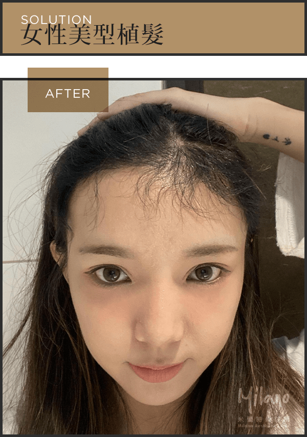女性植髮改善高髮際線術後 圖片