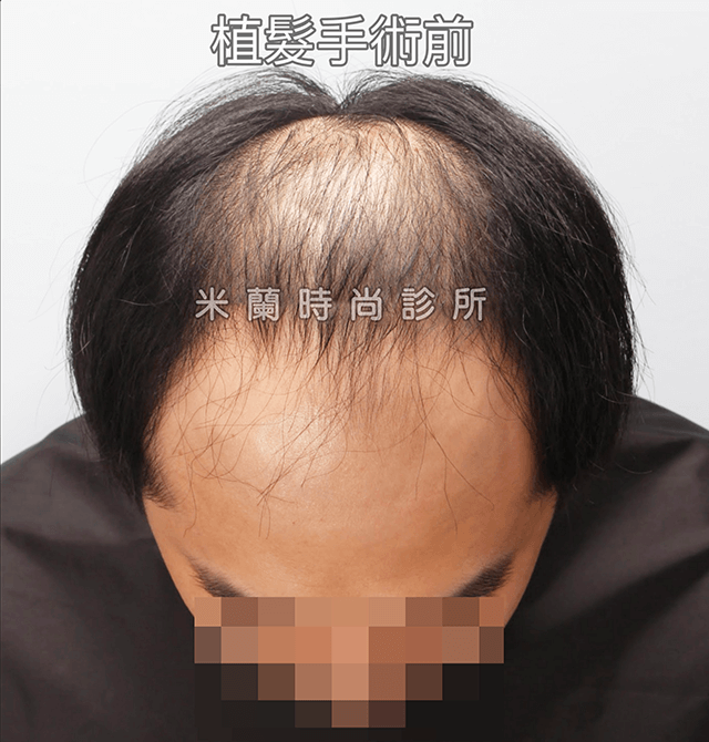 雄性禿第五期FUE巨量植髮手術前低頭