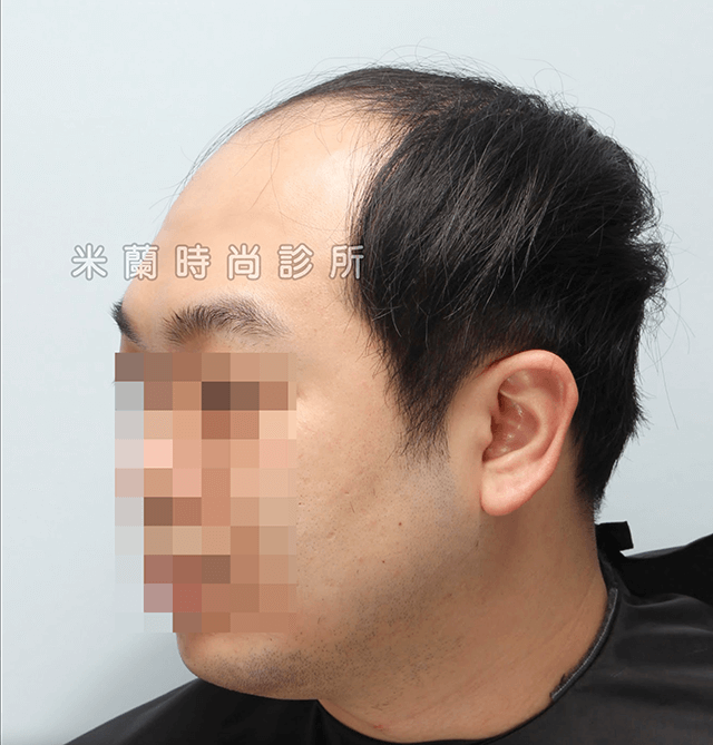 雄性禿第五期FUE巨量植髮術前右側