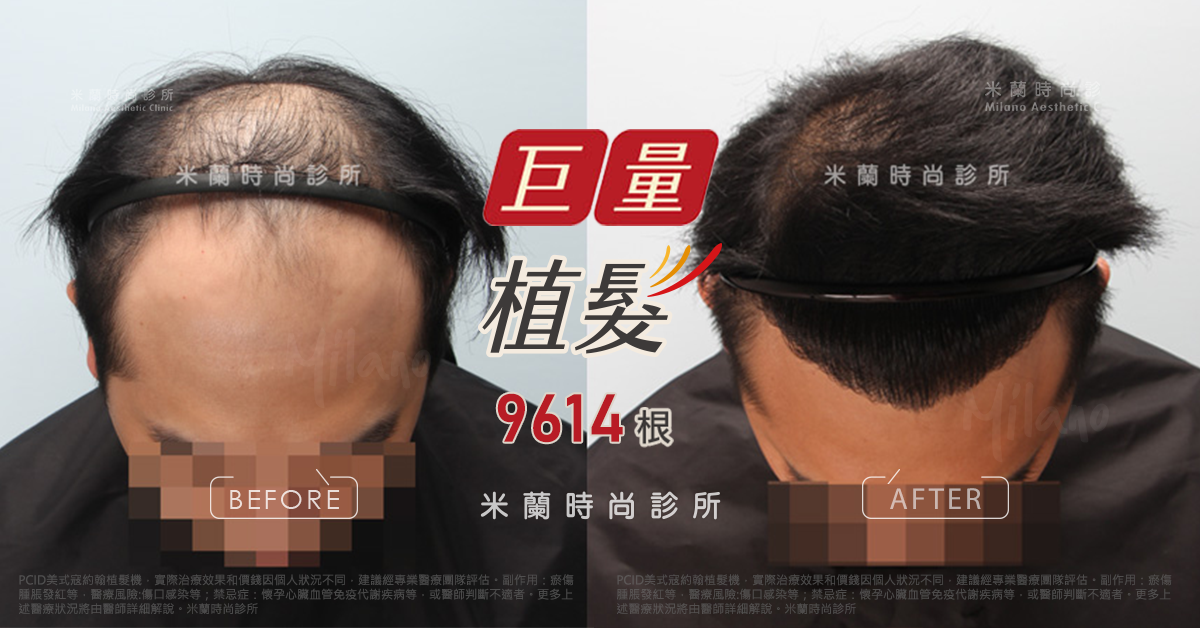 植髮手術後一年髮際線比較