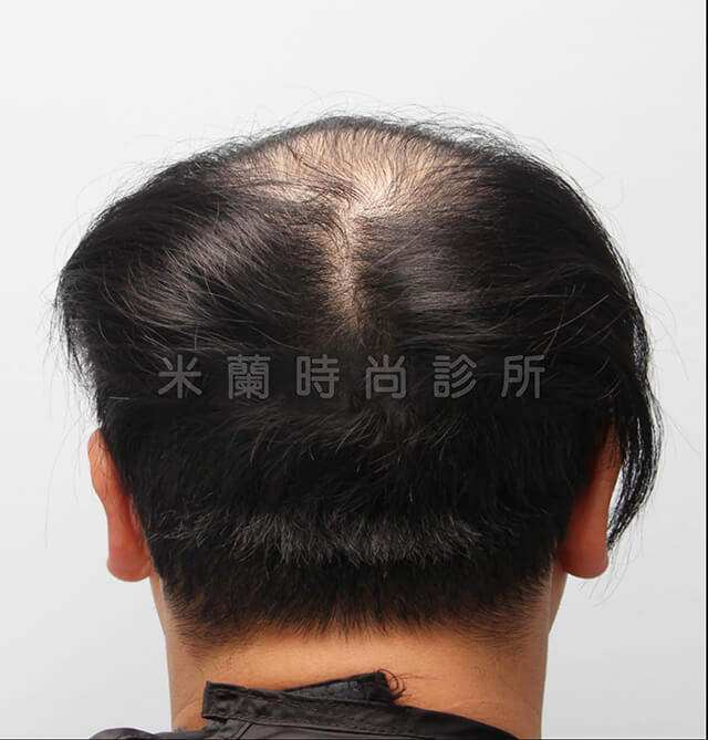 雄性禿第五期FUE巨量植髮術前後腦