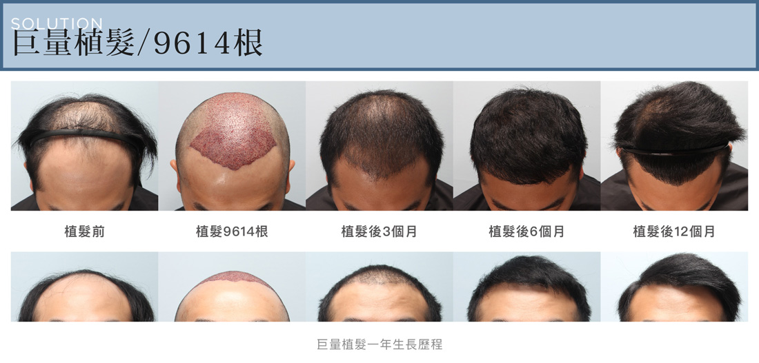 雄性禿第五期FUE巨量植髮一年生長歷程