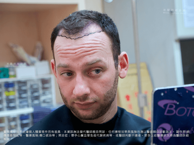 植髮諮詢評估與規劃 圖片