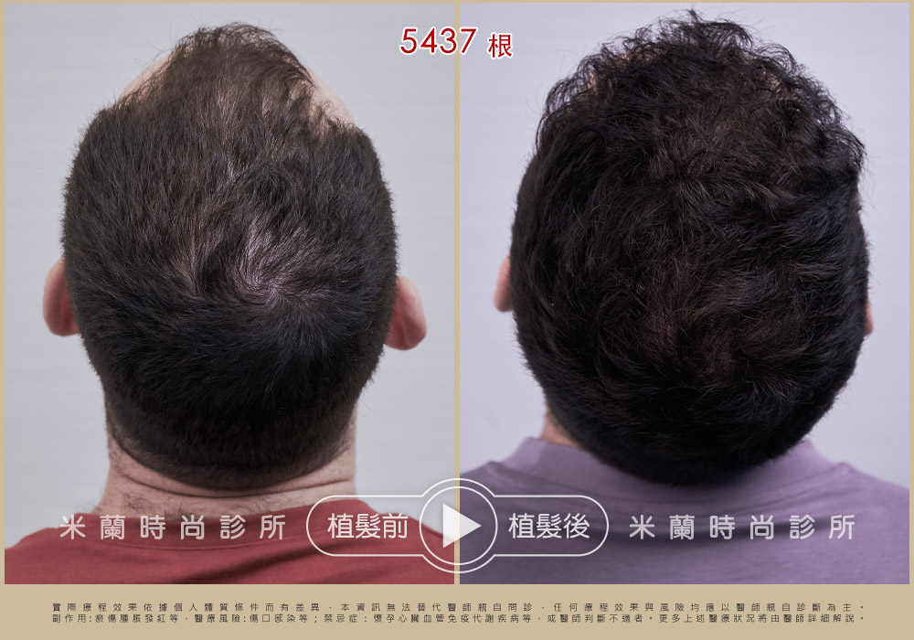 不會影響到後面頭髮的外觀 照片