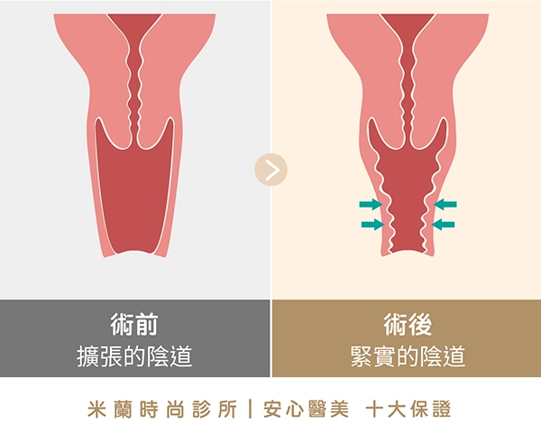 全層陰道緊實手術：由內而外層層縫合