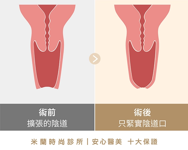 傳統陰道口縫合：僅修飾陰道入口處