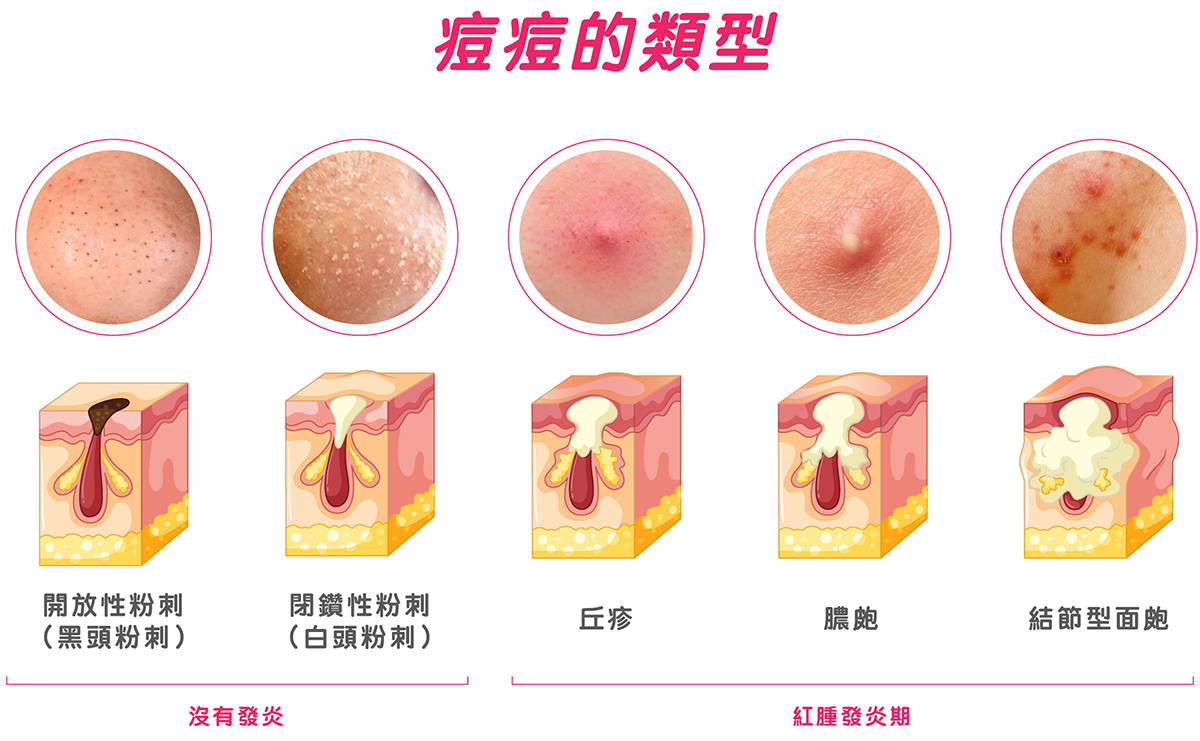 痘痘的類型