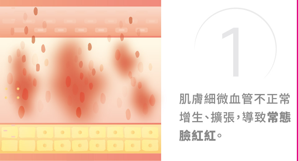 青萃光治療原理圖解1
