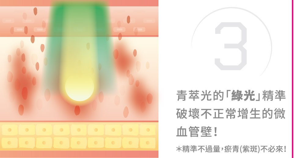 青萃光治療原理圖解3