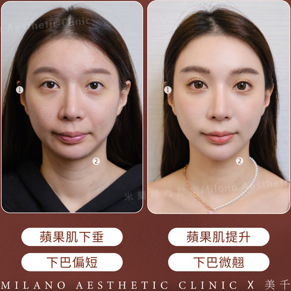 側面輪廓線條的視覺改善