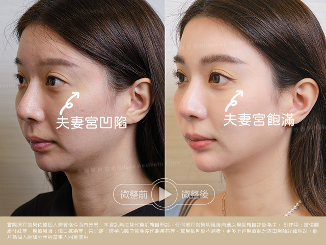 玻尿酸注射填補術後對比照片