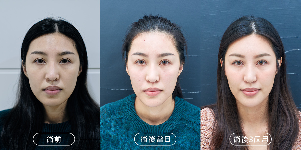 玻尿酸微整形✜情緒美學 術後呈現